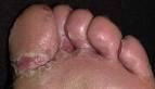 La hormona del crecimiento la psoriasis